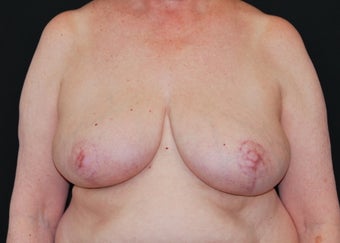 Breast Reduction after 949238