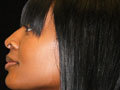 Atlanta Nose Job Surgery before 721903
