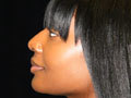 Atlanta Nose Job Surgery after 721903