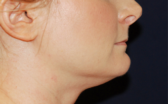 Neck Lift 650172