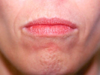 Before and After Upper & Lower Lip Lift before 65360