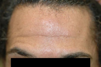 Dysport (Botox) for Men Before and After before 1008617