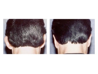 Otoplasty (Ear Surgery) before 1235681