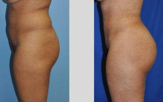 Buttock Augmentation before 271482