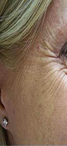 Botox before 967788