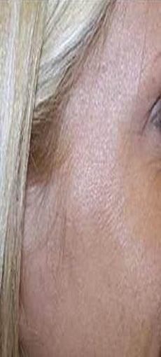 Botox after 967788