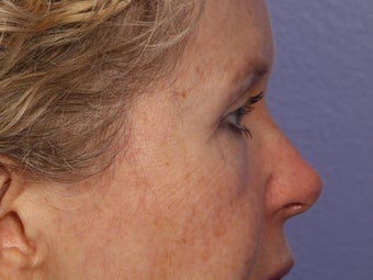 Eyelid Surgery after 280838