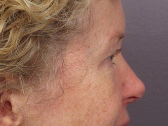 Eyelid Surgery before 280838