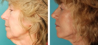 Facelift before 1205206