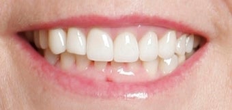 Restoration with Porcelain Veneers after 886650