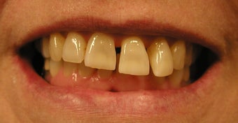 Restoration with Porcelain Veneers before 886650
