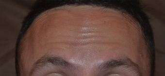 30 Year Old Male Treated for Forehead Lines after 1380337