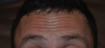 30 Year Old Male Treated for Forehead Lines before 1380337