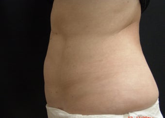Coolsculpting after 495175