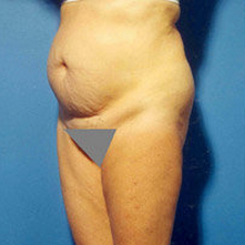 Abdominoplasty 279330