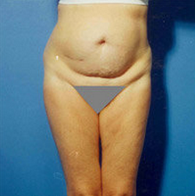 Abdominoplasty before 279330