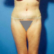 Abdominoplasty after 279330