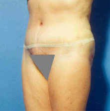 Abdominoplasty 279330