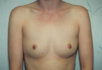 Breast Augmentation before 266785