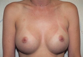 Breast Augmentation after 266785