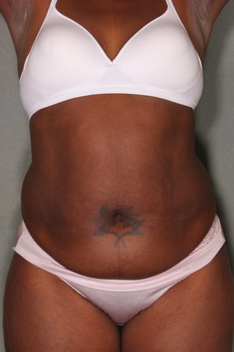 52 Year Old Female Treated for UnWanted Fat With SmartLipo and Vaser Laser before 824748