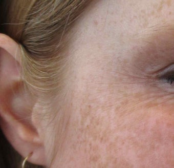 40 year old female with Botox for Crows feet after 1245370