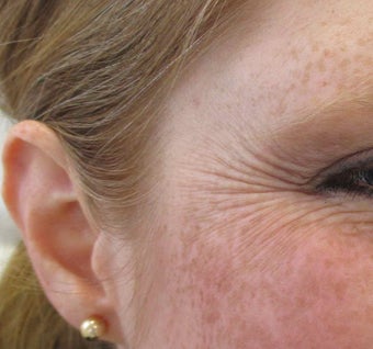 40 year old female with Botox for Crows feet before 1245370