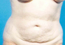 Abdominoplasty before 279332