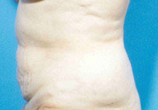 Abdominoplasty 279332