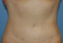 Abdominoplasty after 279332