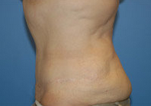 Abdominoplasty 279332