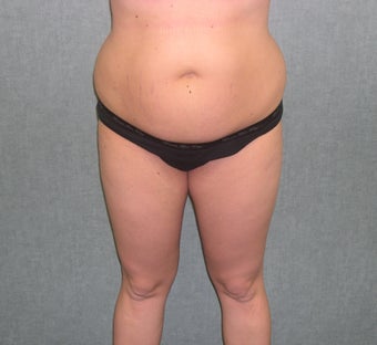 SmartLipo before 607521