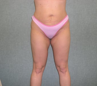 SmartLipo after 607521
