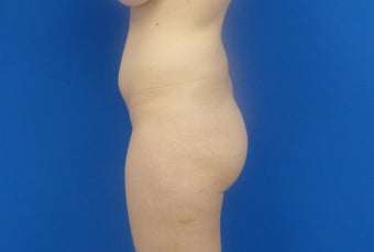 Brazilian Butt Lift via fat transfer 833988