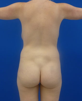 Brazilian Butt Lift via fat transfer before 833988