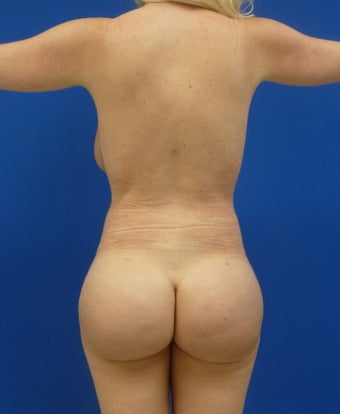 Brazilian Butt Lift via fat transfer after 833988