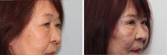 Before and 2 month after double eyelid surgery 683360