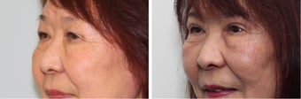 Before and 2 month after double eyelid surgery after 683360