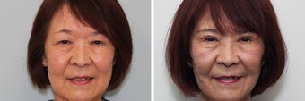 Before and 2 month after double eyelid surgery before 683360