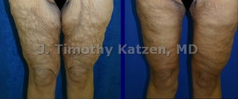 Leg Lift after weight loss surgery before 660701