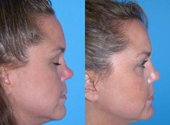 Non-surgical rhinoplasty before 640430