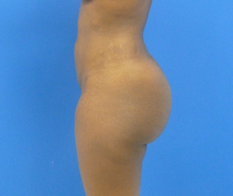 Brazilian Butt Lift - via fat transfer 636804