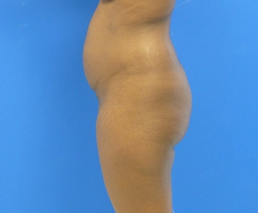 Brazilian Butt Lift - via fat transfer 636804