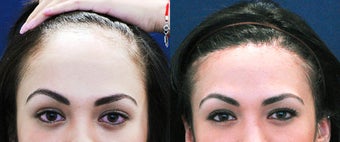 Forehead Reduction Surgery or Hairline Lowering Surgery after 323754