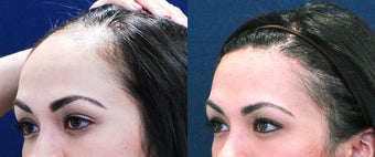 Forehead Reduction Surgery or Hairline Lowering Surgery before 323754