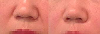 ArteFill Before and After, 51 year old female before 1232380