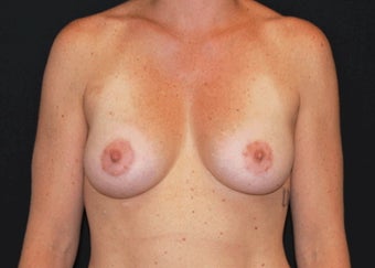 Breast Lift after 949222