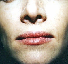 lip augmentation with fat after 1054166