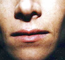lip augmentation with fat before 1054166