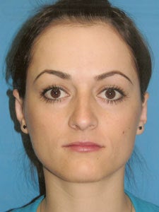 Otoplasty Ear Surgery - Female after 818044